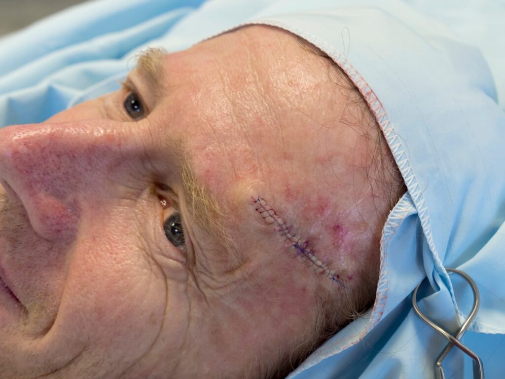Middle-aged man after receiving mohs surgery.