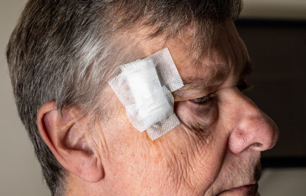 Man with gauze on his face after mohs surgery.