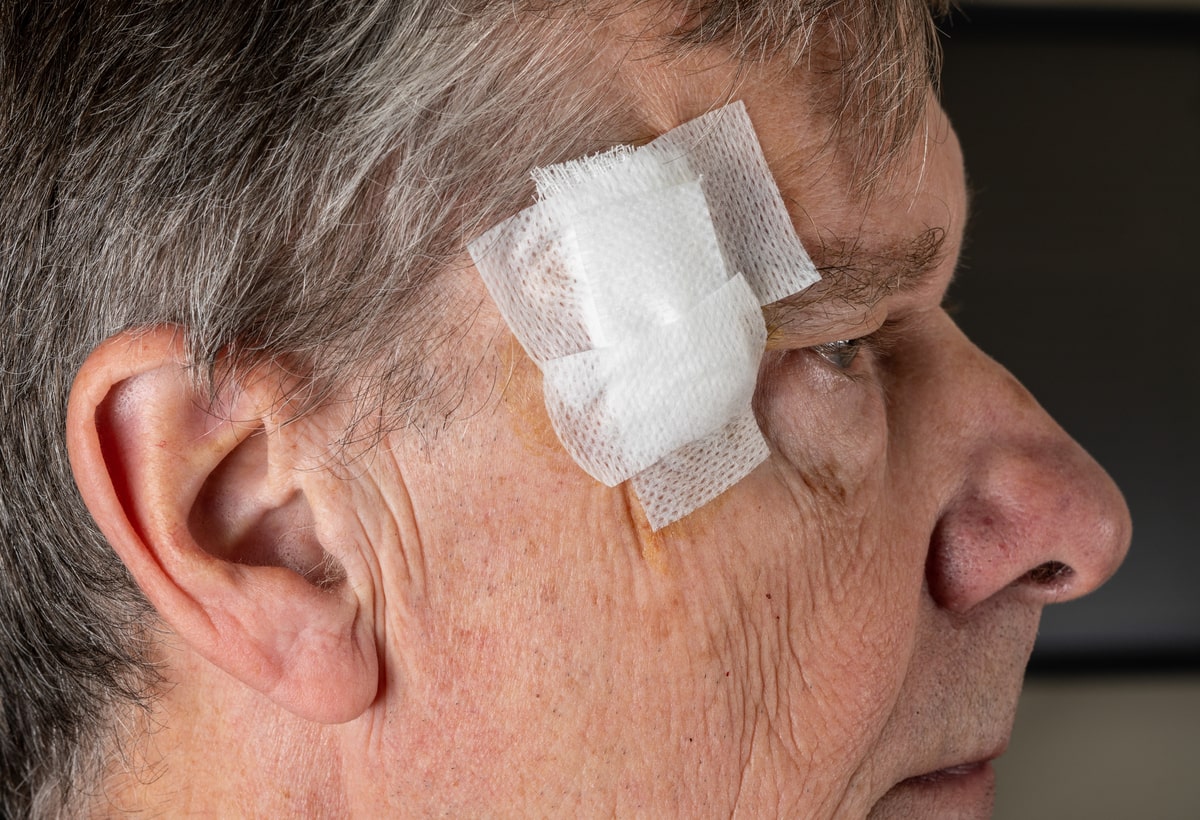 Middle-aged man with a gauze on his head during his Mohs Surgery Recovery