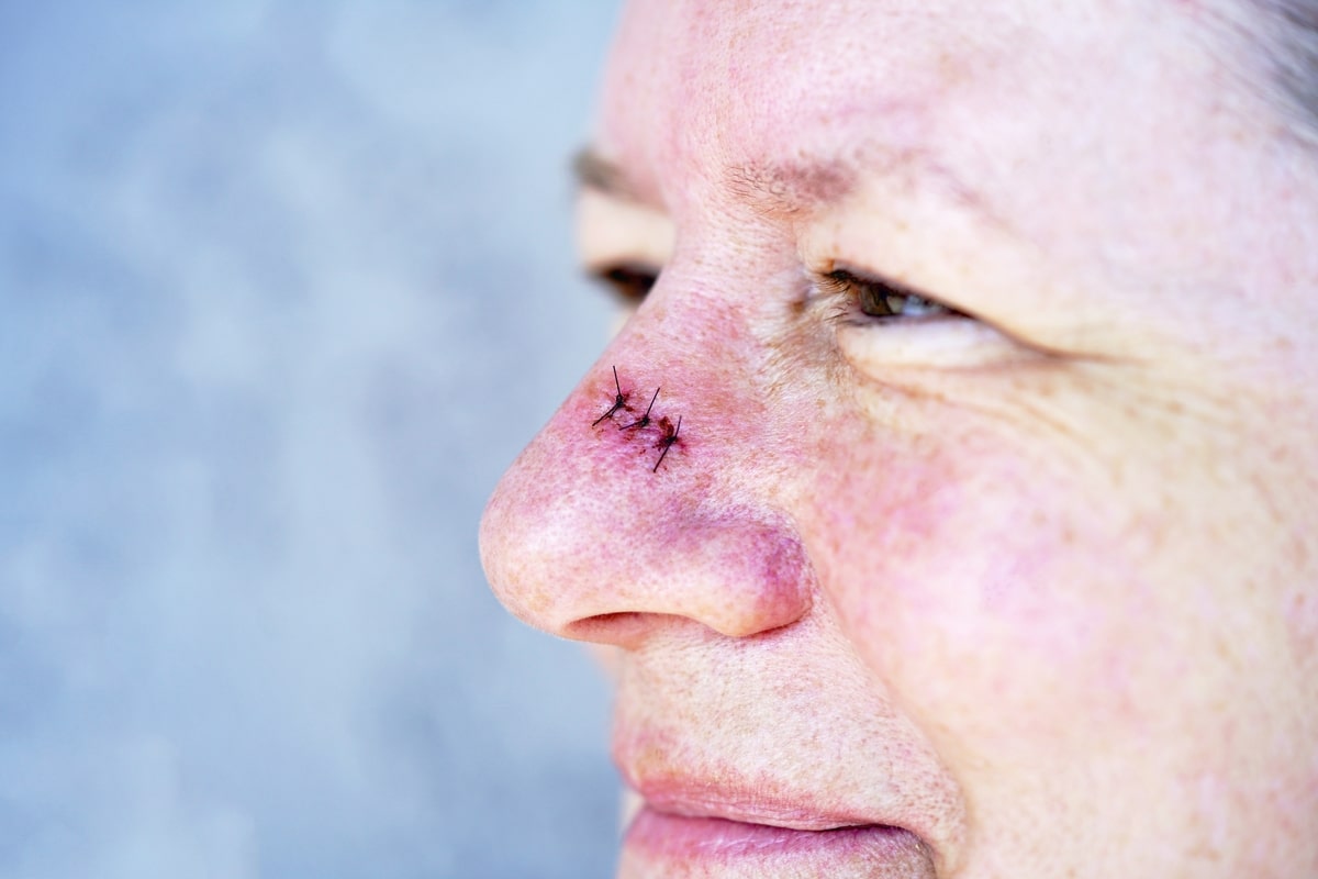 The Precision Of Mohs Surgery: Why It's the Go-To For Nose Skin Cancer