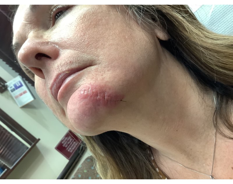 Top Tips for Mohs Surgery Recovery: Insights from Dermatology Experts