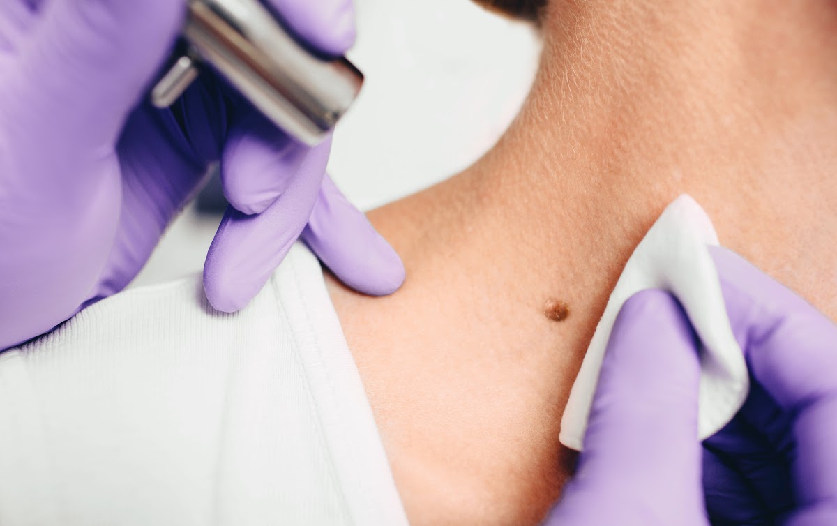 Safe And Effective Skin Tag Removal: What You Need To Know